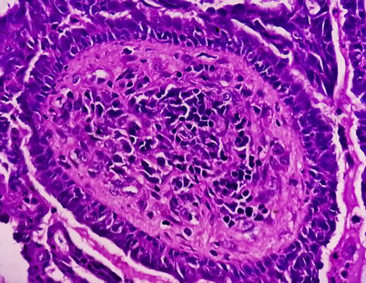 Vue au microscope d'un papillomavirus humain